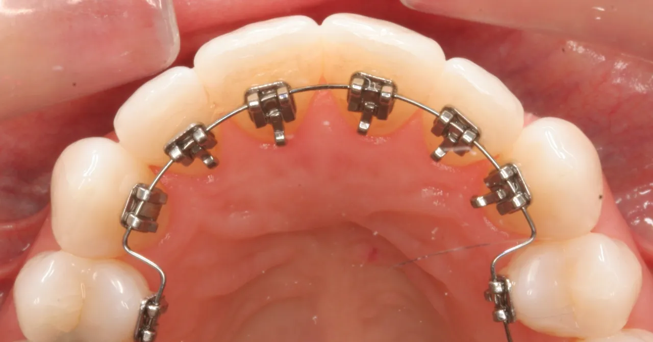 aparat lingwalny vs nakładki ortodontyczne