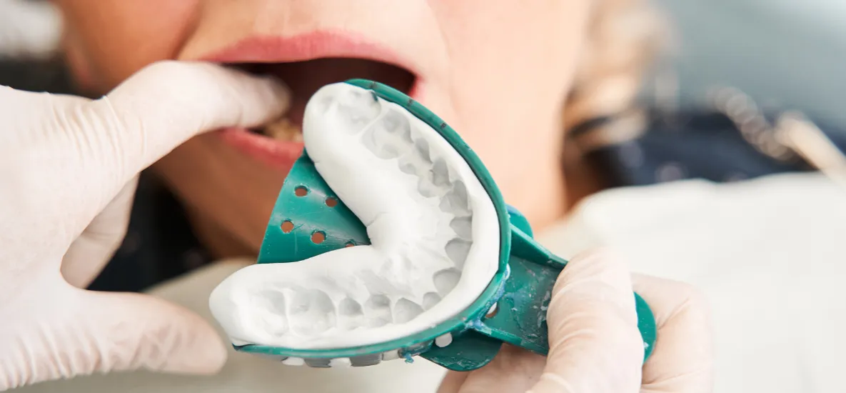 pobieranie wycisku zęb&oacute;w szyna