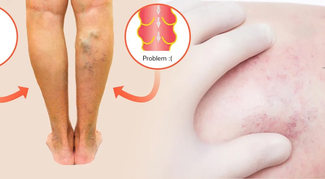 objawy zakrzepicy żył głębokich