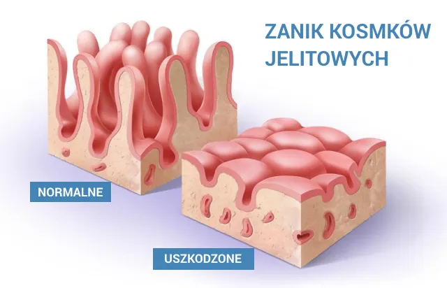 Uszkodzone kosmki jelitowe w celiakii