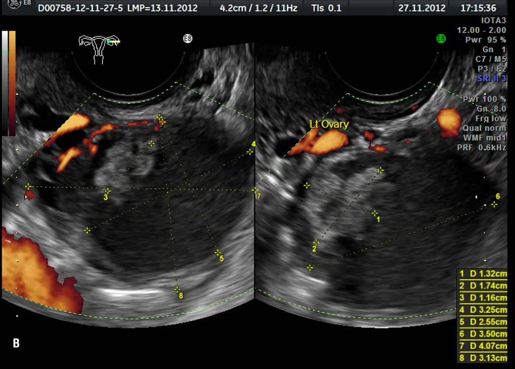schemat endometriozy, torbiel jajnika USG