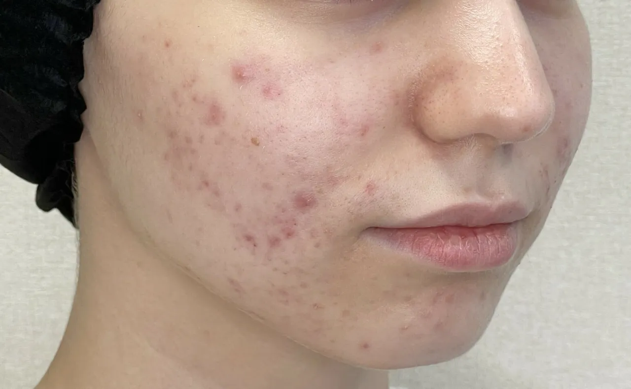 Skuteczne składniki aktywne na trądzik