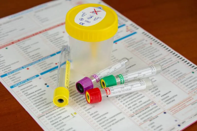 Wyniki badania kwasu moczowego normy