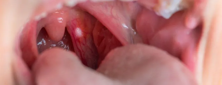 Przyczyny powstawania aft i ran w jamie ustnej