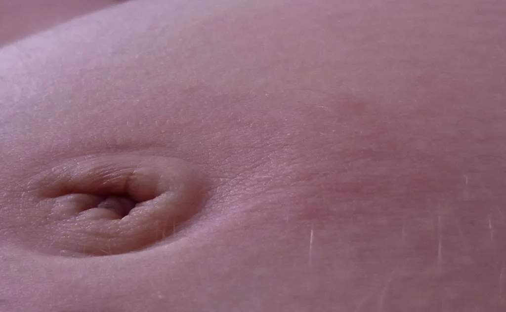 zaczerwieniona skóra wokół pępka u kobiety w ciąży, zdjęcie medyczne, bez drastycznych scen