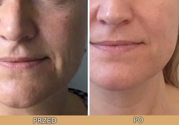 Efekty stosowania serum z witaminą C przed i po