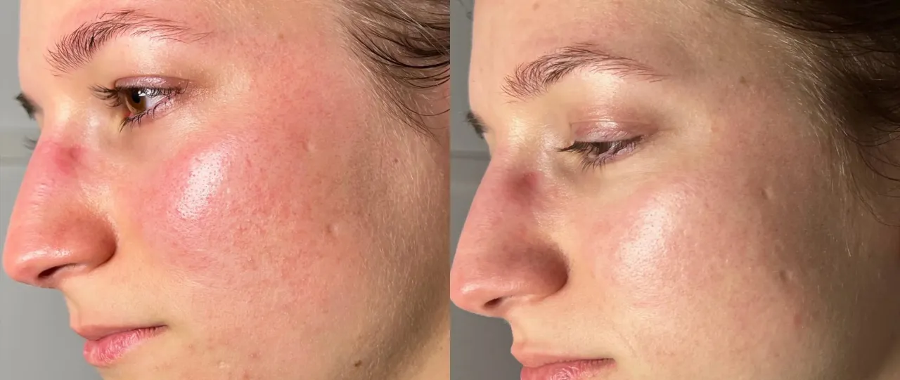 Dermika Hydralogiq efekty przed po