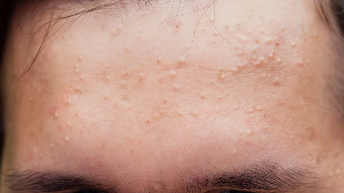 Domowe sposoby na pryszcze olejek herbaciany lód glinka