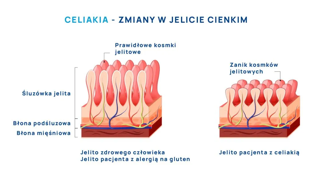 objawy jelitowe nadwrażliwość na gluten infografika
