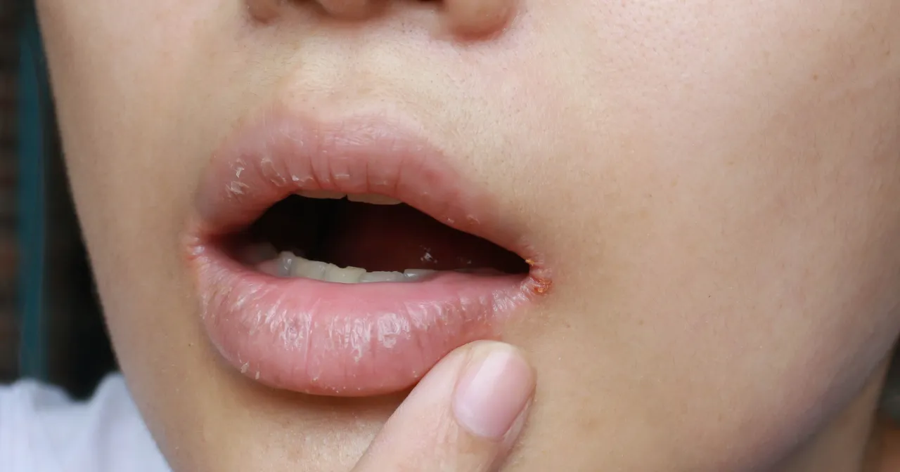 zajady kąciki ust bolesne pęknięcia