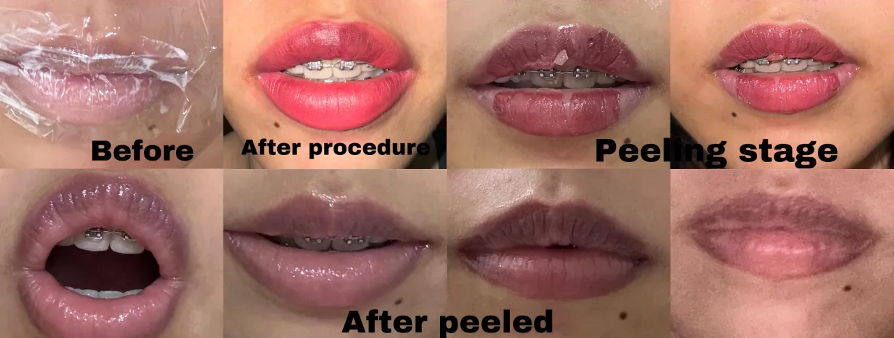 opuchlizna po makijażu permanentnym ust normalna vs niepokojąca