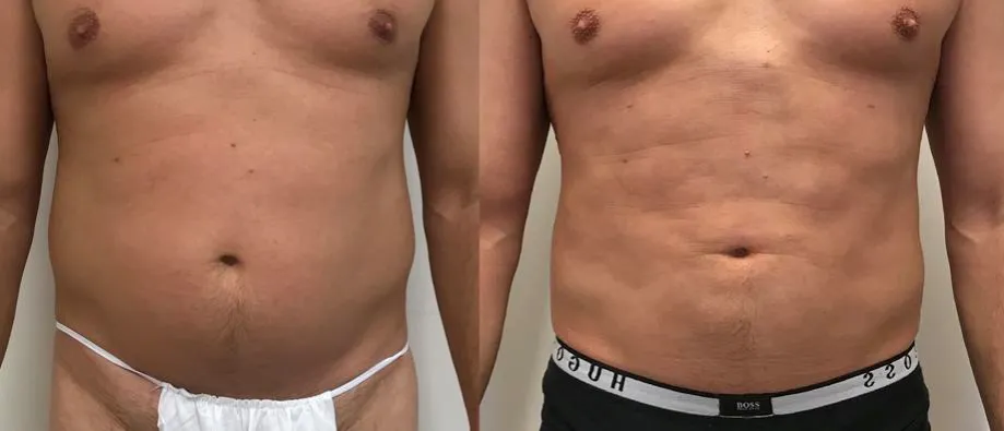 Cennik liposukcji przykładowy