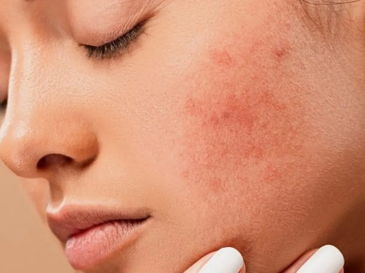 cykl powstawania pryszcza, etapy trądziku, zablokowany por