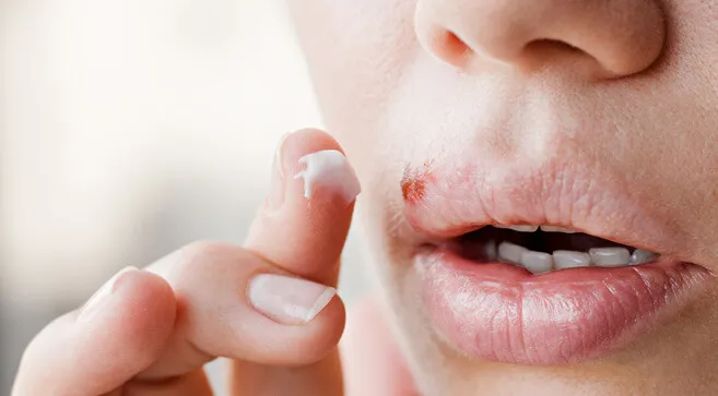 Zdjęcie Opryszczka czy pryszcz: jak je odróżnić i uniknąć pomyłek