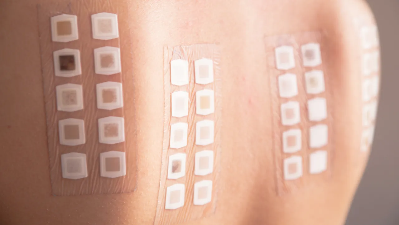 testy płatkowe na alergię nikiel