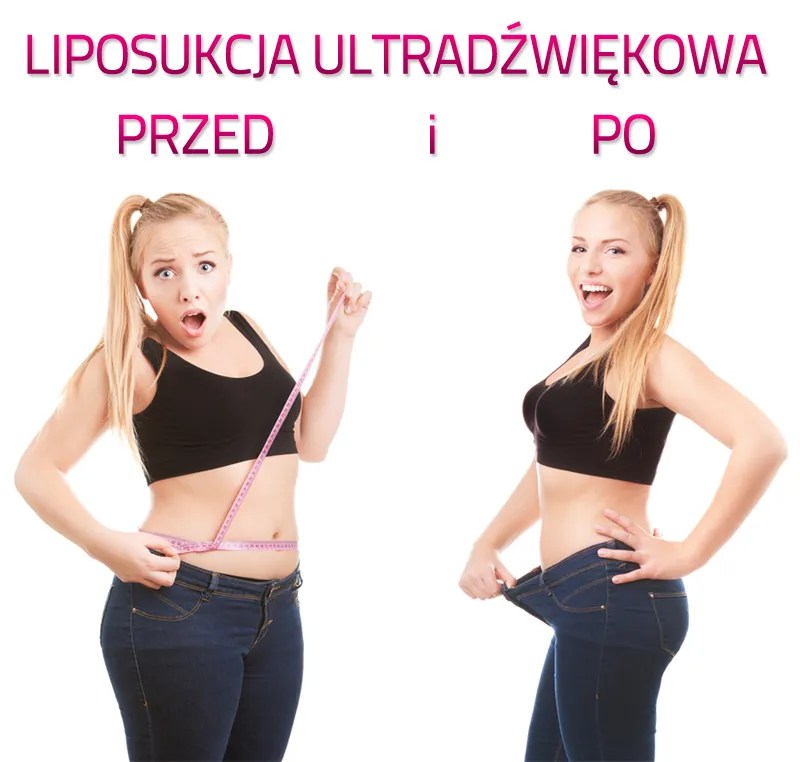 Przeciwwskazania do liposukcji infografika