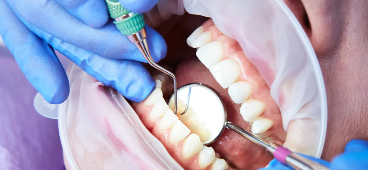 szynowanie zęb&oacute;w wł&oacute;knem szklanym