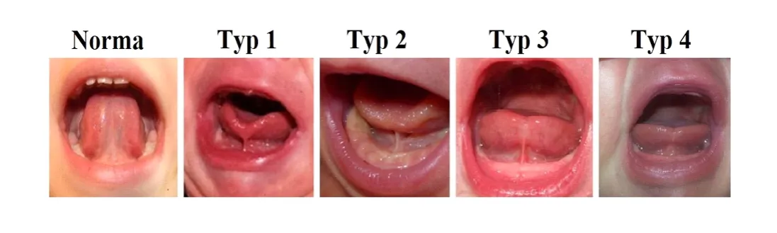 prawidłowe i skrócone wędzidełko podjęzykowe porównanie