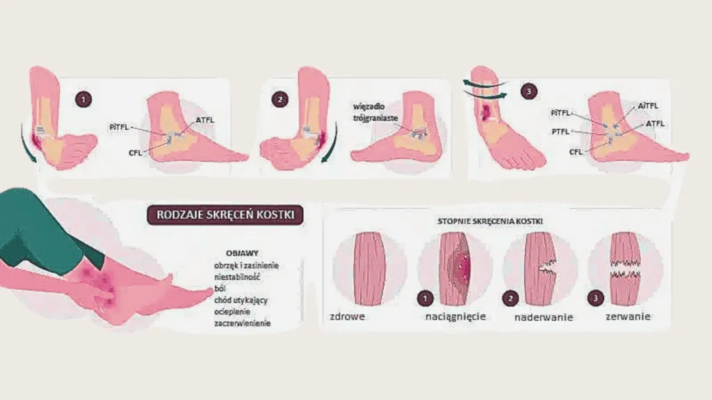 stopnie skręcenia kostki infografika