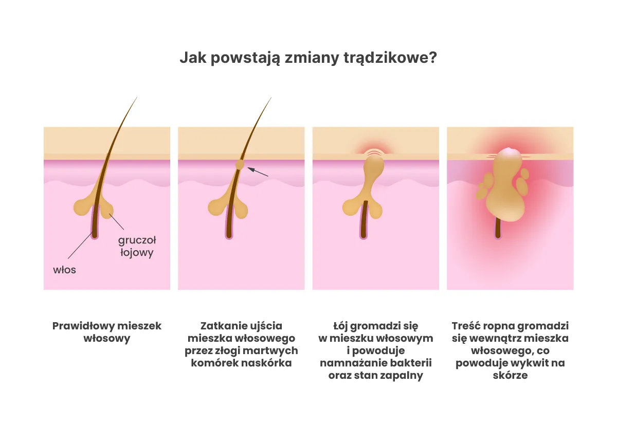 składniki aktywne na trądzik młodzieńczy