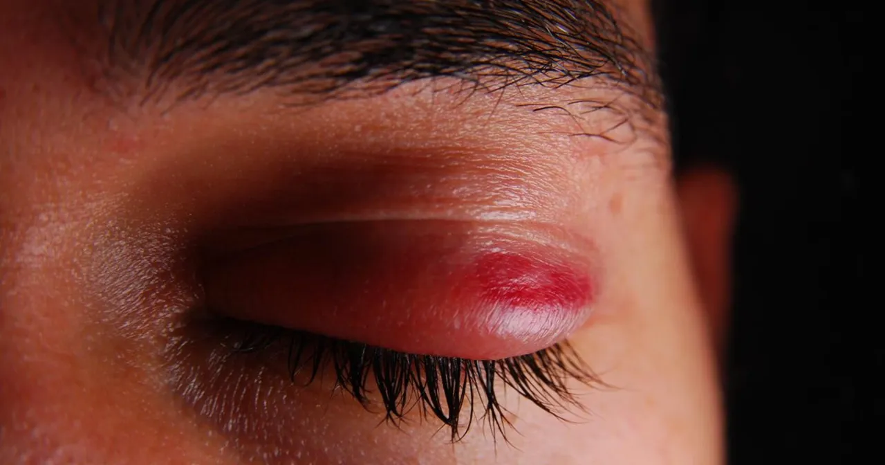 Opuchnięte oczy rano przyczyny