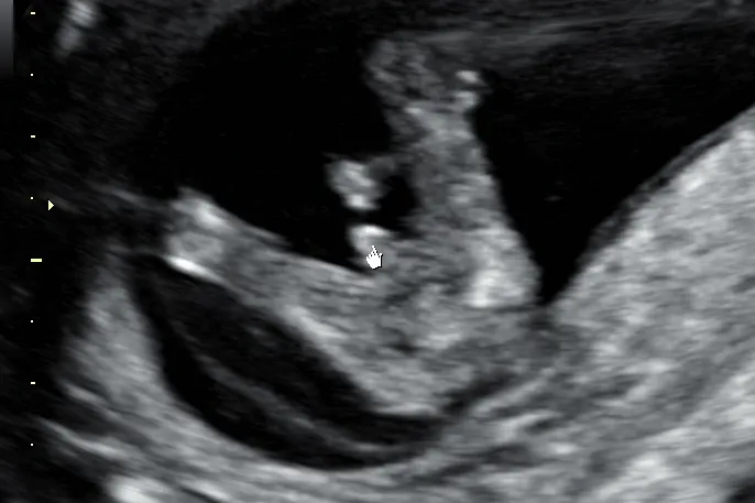 USG ciąży poł&oacute;wkowe płeć dziecka