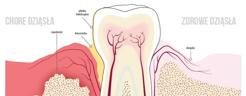 zdrowe i chore dziąsła porównanie