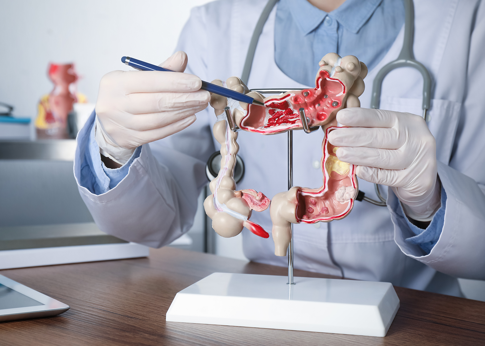 Optymalny czas na chemioterapię po operacji jelita grubego