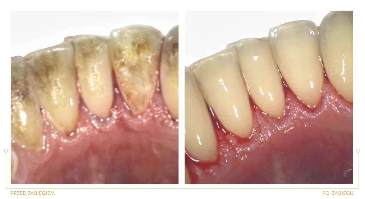 Piaskowanie zębów efekt przed i po: zęby z kamieniem i przebarwieniami po zabiegu lśniąco czyste.