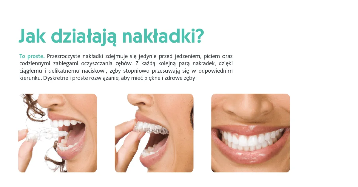 Zdjęcie Nakładki na zęby w których można jeść – komfort bez ograniczeń