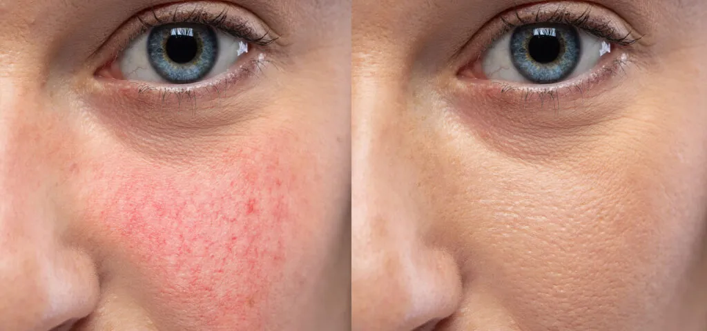 cera naczynkowa charakterystyka objawy