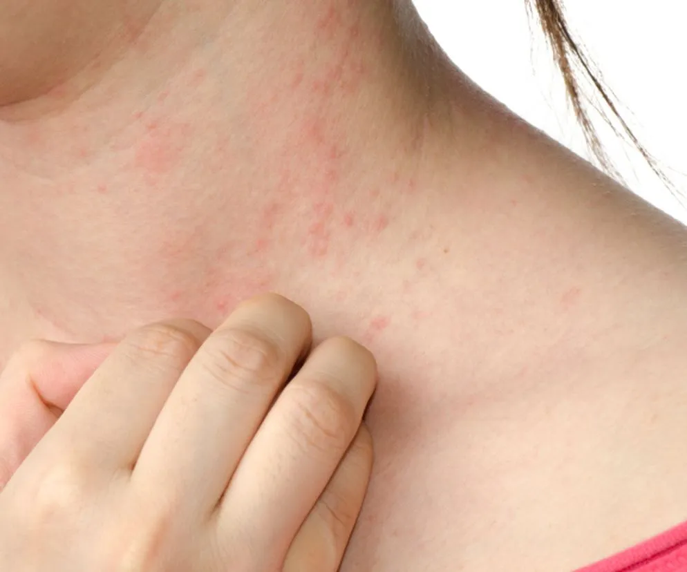 Objawy alergii na leki sk&oacute;rne oddechowe