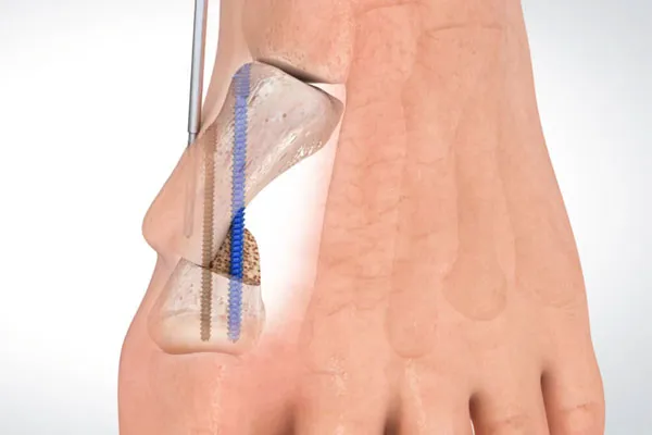 rodzaje znieczulenia operacja haluksa infografika