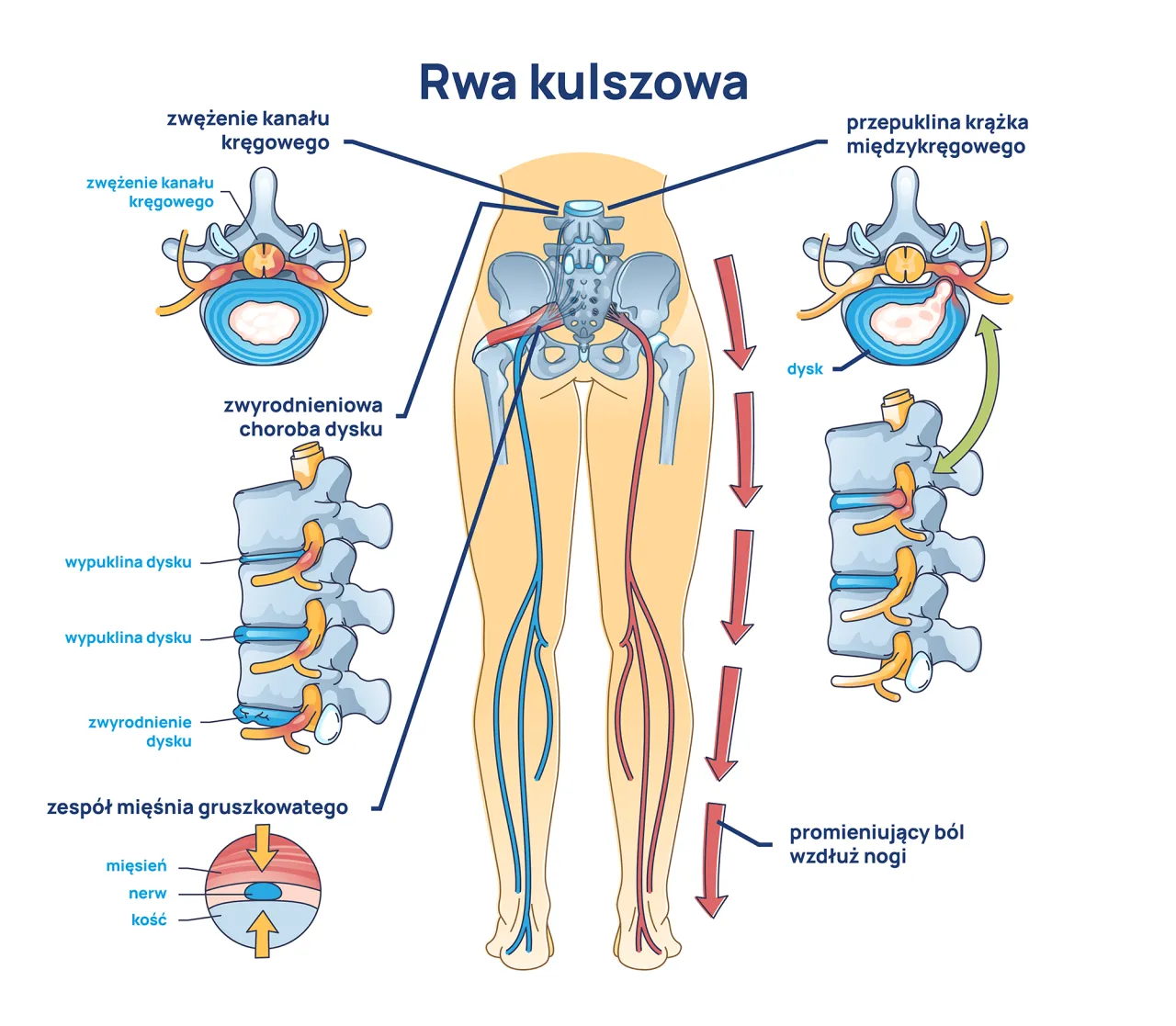 rwa kulszowa schemat promieniowania bólu