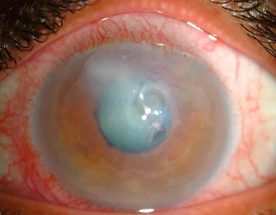 oko w wodzie soczewki kontaktowe