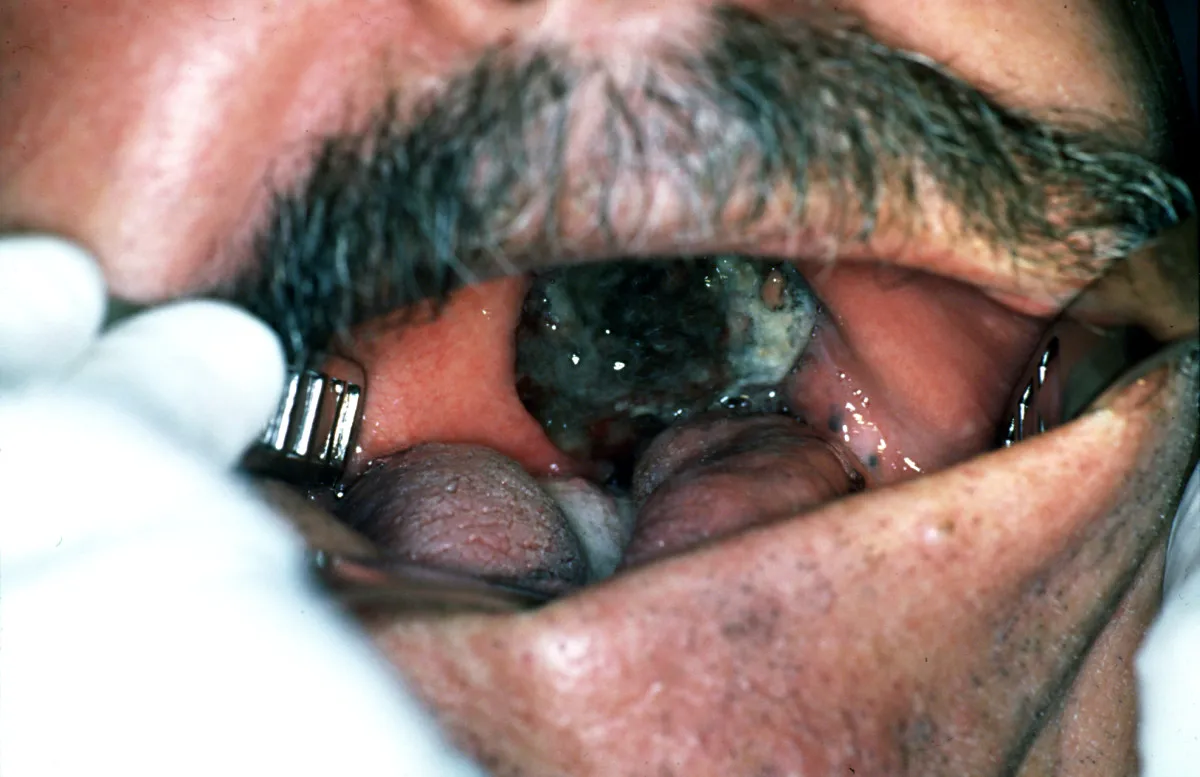 Czerniak jamy ustnej wygląd zdjęcia