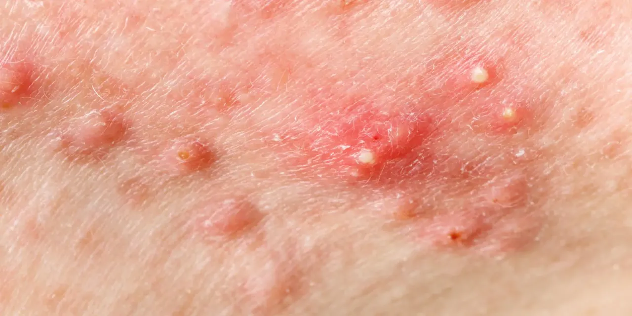 Domowe sposoby na pryszcze