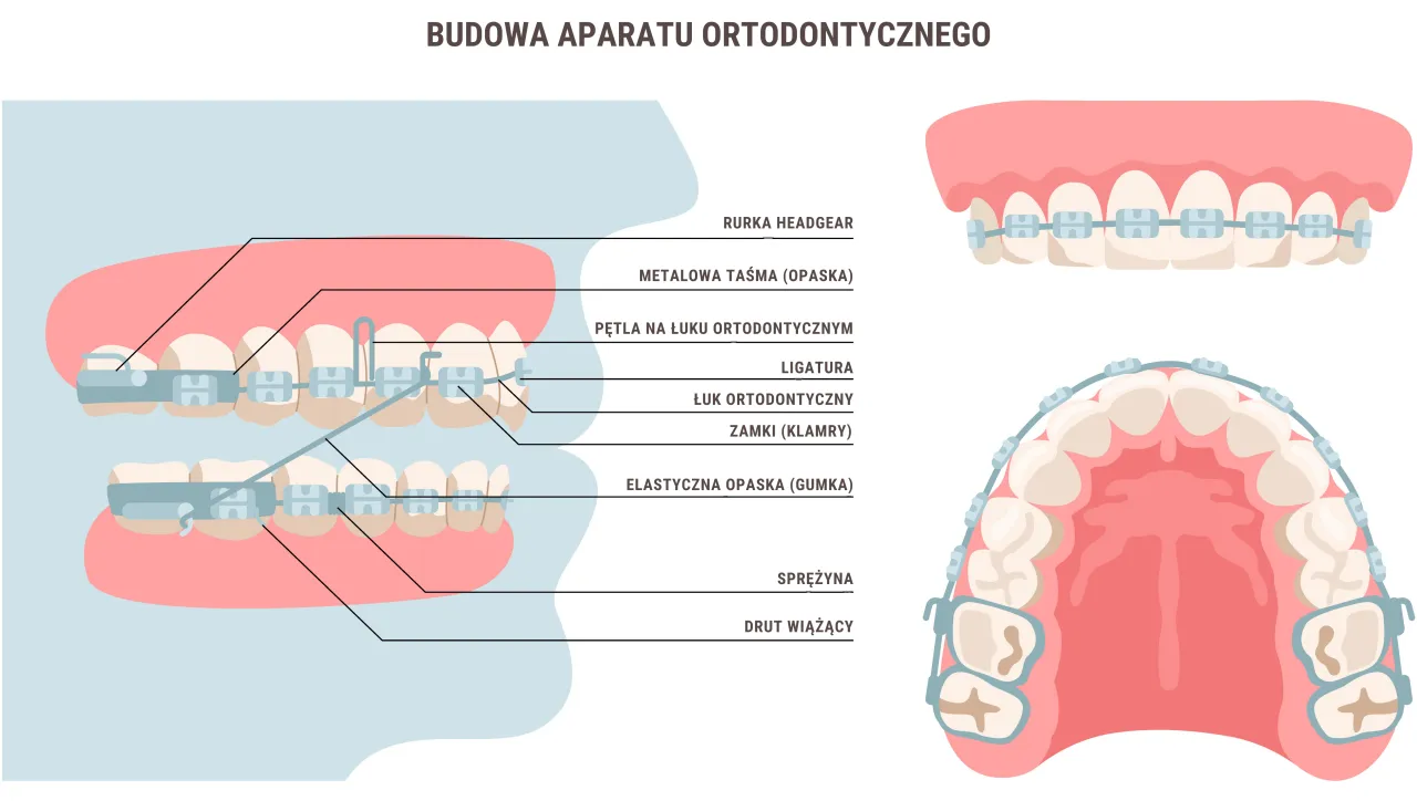 budowa klasycznego aparatu ortodontycznego schemat