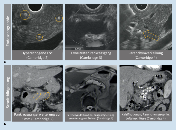 Chronische Pankreatitis Diagnostik Bildgebung &Uuml;bersicht