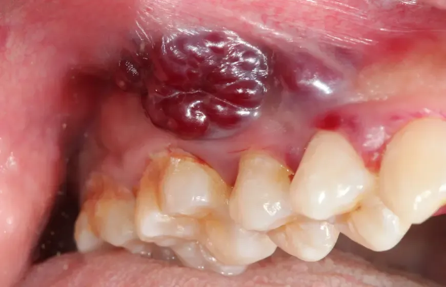 guzek na dziąśle rak zdjęcia