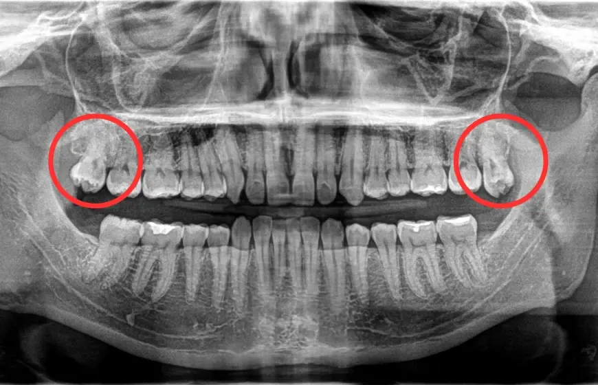 zdjęcie pantomograficzne zęby mądrości