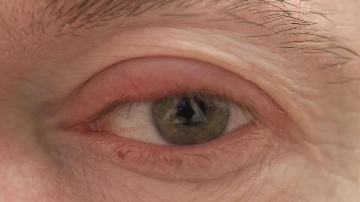 domowe sposoby na bolące oczy, okłady z ziemniaka og&oacute;rka herbaty