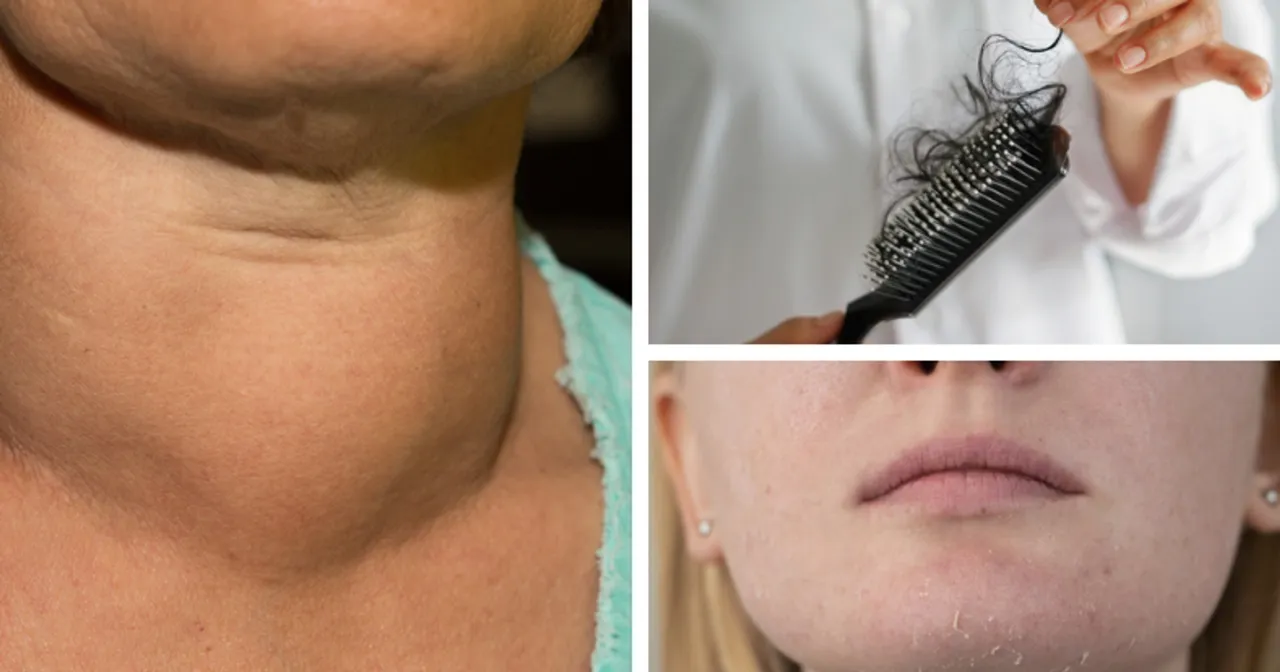 Objawy niedoboru jodu zmęczenie wypadanie włos&oacute;w