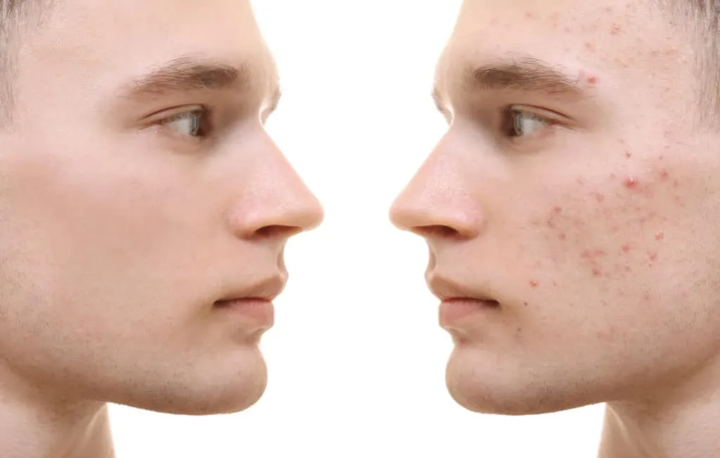 Zdjęcie Unreine Gesichtshaut: Ursachen, Symptome und effektive Behandlungen