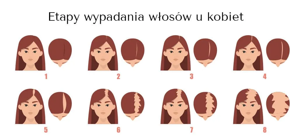 Zdjęcie Wypadanie włosów jakie badania wykonać, by znaleźć przyczynę problemu?