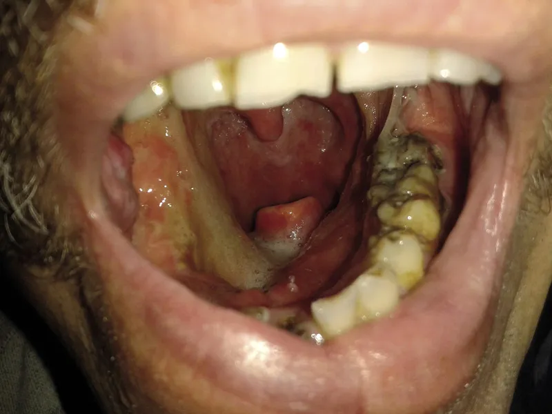 Zdjęcie Rak dna jamy ustnej objawy - nie bagatelizuj niepokojących sygnałów