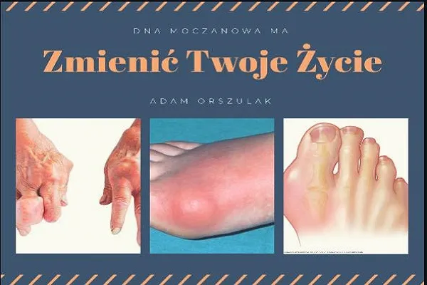 Zdjęcie Dna moczanowa jaki lekarz najlepiej pomoże - poznaj wszystkich specjalistów