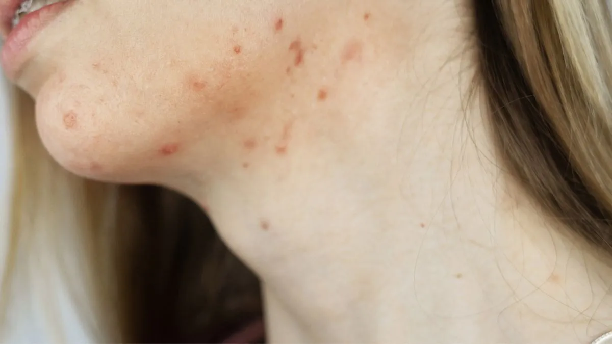 Zdjęcie Jak pozbyć się pryszcza podskórnego – skuteczne metody i porady