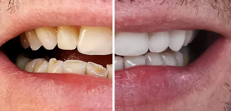 r&oacute;żnica bonding lic&oacute;wki