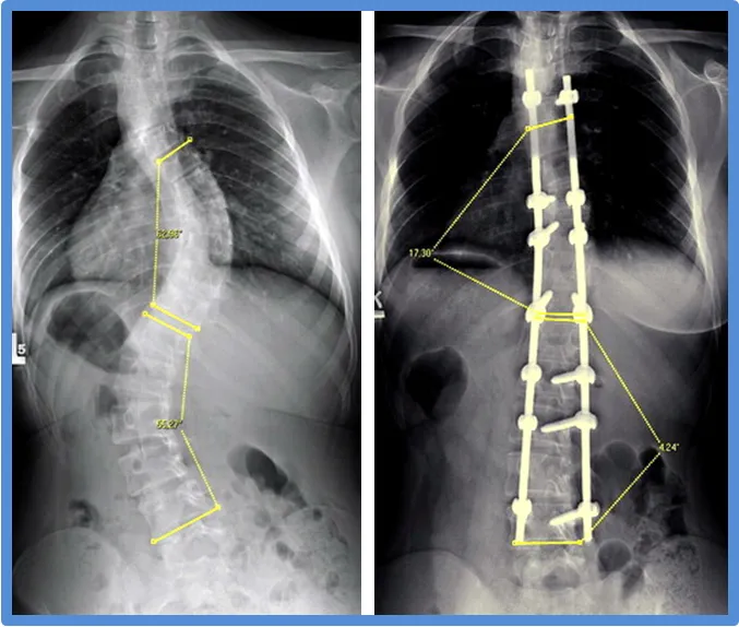 rehabilitacja po operacji kręgosłupa skolioza
